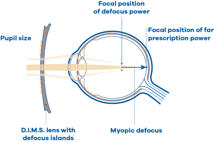 Cross-section of a D.I.M.S. lens in front of an eye. Light through the lens focuses the far prescription power on the retina, while light through the defocus islands focuses in front of it, creating myopic defocus. Labels mark pupil size, the D.I.M.S. lens with defocus islands, the focal position of defocus power and the focal position of far prescription power