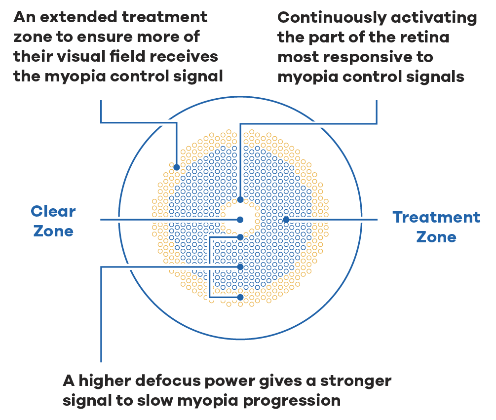 Annotated diagram of a MiYOSMART iQ lens: a clear zone at the centre and a
                    treatment zone of defocus segments around it. Callouts note an extended treatment
                    zone so more of the visual field receives the myopia control signal, continuous
                    activation of the part of the retina most responsive to myopia control signals,
                    and a higher defocus power giving a stronger signal to slow myopia progression.