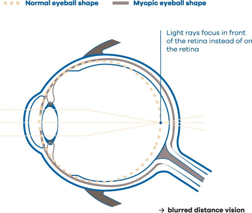 Cross-section diagram comparing a normal eyeball with a longer myopic eyeball: in the myopic eye the light rays focus in front of the retina instead of on it, which gives blurred distance vision